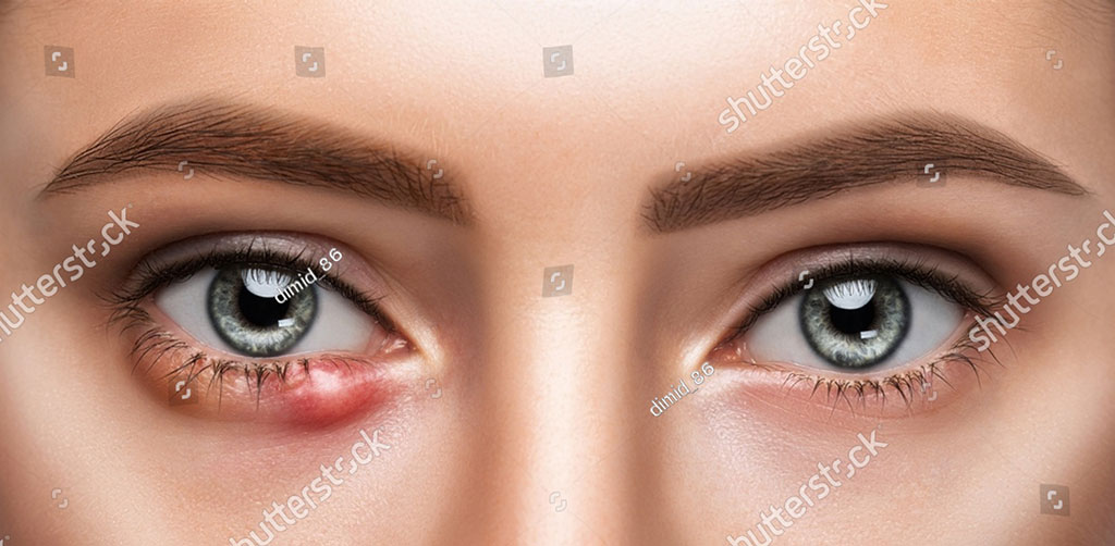   گوہانجنی,آنکھ کی پھنسی, گہانجنی, گونہہ دھڑکی,گہیری, آنی, گونہہ ترکی,گوانڈنی,گوانڈھنی,گوہانگنی,گوہائی,گونہہ تلکی,گونہہ تڑکی ,گونہہ دھڑکی,گترکی,روہا,روہے, آنکھوں کی بیماری,گہیری, A sty in the eye, guhaaNDani, ਗੁਹਾਂਡਣੀ,guhaaNDhani,  ਗੁਹਾਂਢਣੀ,guhaaNjhani,   ਗੁਹਾਂਝਣੀ,rohe, ਰੋਹੇ,گوہانجنی  ,gohaaNjni, ਗੁਹਾਂਜਣੀ, 